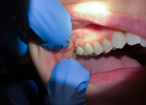 Best Emergency Tooth Extraction in Plumsteadville, PA